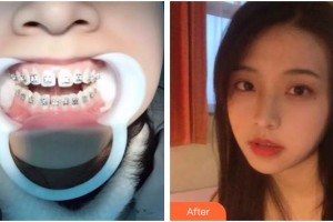 臺州牙博士口腔門診部劉丹旭整形價格表附隱形托槽矯正案例展示