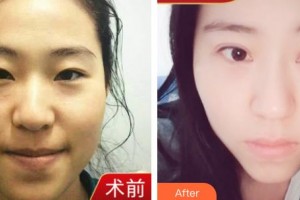 臺州國際眼科醫(yī)院姜珺整形價格表附眼部綜合案例展示