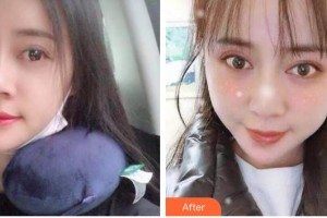 臺州牙科醫(yī)院林青整形價格表附自鎖托槽矯正案例展示