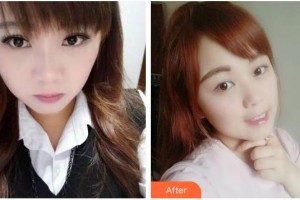 臺州牙科醫(yī)院許麗霞整形價格表附牙齒隱形矯正案例展示