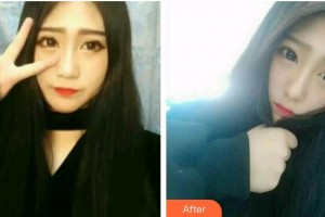 臺州牙科醫(yī)院邱偉強(qiáng)整形價格表附牙齒隱形矯正案例展示