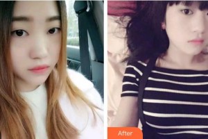 臺(tái)州貝雅口腔醫(yī)院王文敏整形價(jià)格表附金屬托槽矯正案例展示