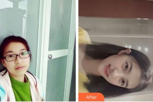 臺(tái)州康貝佳口腔醫(yī)院宋文斯整形價(jià)格表附金屬托槽矯正案例展示