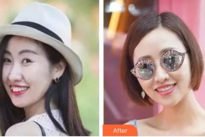 臺(tái)州牙博士口腔門診部梁星天整形價(jià)格表附隱形托槽矯正案例展示