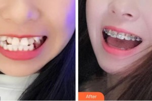臺(tái)州牙博士口腔門診部簡(jiǎn)小沖整形價(jià)格表附金屬托槽矯正案例展示