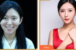 臺(tái)州國際眼科醫(yī)院葉正輝整形價(jià)格表附眼部綜合案例展示