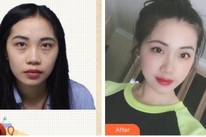 臺(tái)州國際眼科醫(yī)院王時(shí)力整形價(jià)格表附激光去眼袋案例展示