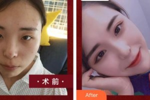 臺(tái)州國際眼科醫(yī)院張佳整形價(jià)格表附眼部綜合案例展示