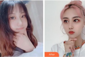 臺(tái)州國際眼科醫(yī)院宋慧洋整形價(jià)格表附眼部綜合案例展示