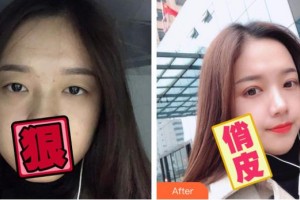 臺(tái)州國際眼科醫(yī)院姜儉整形價(jià)格表附切開雙眼皮案例展示