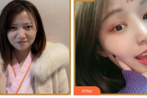 臺(tái)州國際眼科醫(yī)院卓佐跑整形價(jià)格表附眼部綜合案例展示