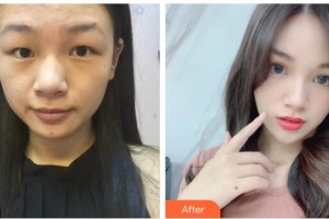 臺(tái)州國際眼科醫(yī)院胡劼整形價(jià)格表附切開雙眼皮案例展示