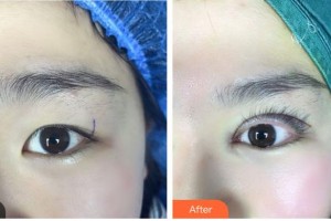 臺州國際眼科醫(yī)院沈咲整形價(jià)格表附眼部綜合案例展示