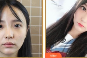 臺州國際眼科醫(yī)院白建海整形價(jià)格表附眼部綜合案例展示