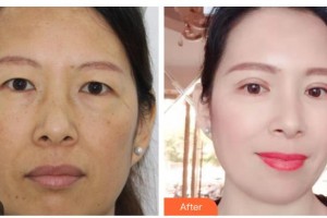 臺州國際眼科醫(yī)院王肖整形價(jià)格表附切開雙眼皮案例展示