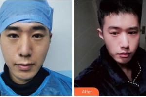 臺州國際眼科醫(yī)院王毓琴整形價(jià)格表附眼部綜合案例展示