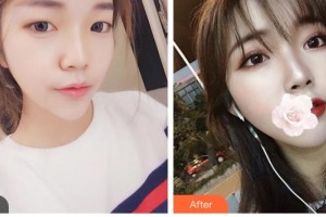 臺州國際眼科醫(yī)院趙澤林整形價(jià)格表附切開雙眼皮案例展示