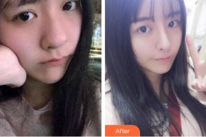 深圳美芮（原雅唯）醫(yī)療美容門診部符國興整形價格表附熱瑪吉多方面部案例展示