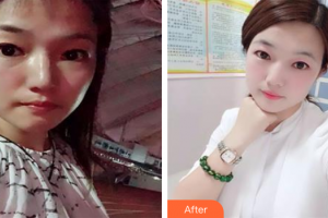 深圳博愛醫(yī)院整形美容中心周春香整形價格表附光子嫩膚案例展示