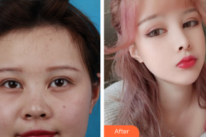 深圳銘醫(yī)醫(yī)療美容醫(yī)院裴南錫整形價格表附耳軟骨鼻部手術案例展示