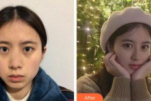 深圳芝華醫(yī)療美容門診部高順福整形價(jià)格表附鼻部手術(shù)案例展示