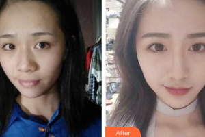 深圳韓美爾醫(yī)療美容門診部高羅鏞整形價格表附鼻部手術案例展示