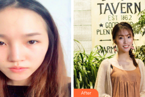 深圳銘醫(yī)醫(yī)療美容醫(yī)院張青松整形價格表附鼻部手術案例展示