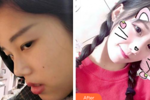 深圳悅己醫(yī)療美容醫(yī)院劉學(xué)鋒整形價(jià)格表附鼻部手術(shù)案例展示