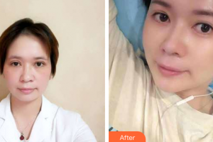 深圳銘醫(yī)醫(yī)療美容醫(yī)院高旭整形價(jià)格表附切開雙眼皮案例展示