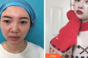 臺州國際眼科醫(yī)院馬慧香整形價(jià)格表附眼部修復(fù)案例展示