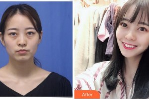 臺州國際眼科醫(yī)院李英姿整形價(jià)格表附切開雙眼皮案例展示