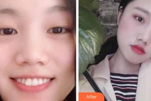 臺州國際眼科醫(yī)院李瑾整形價(jià)格表附切開雙眼皮案例展示