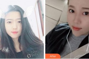 臺州國際眼科醫(yī)院林冰整形價(jià)格表附切開雙眼皮案例展示