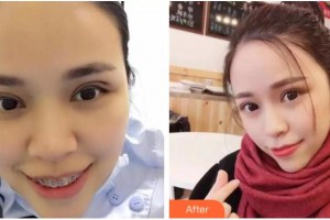 臺州國際眼科醫(yī)院余新平整形價(jià)格表附切開雙眼皮案例展示