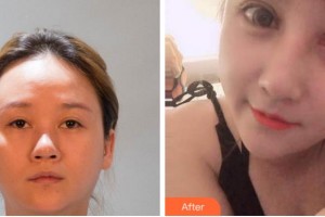 臺州國際眼科醫(yī)院張芳整形價(jià)格表附眼部綜合案例展示