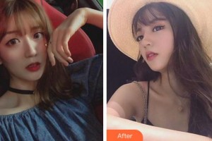 臺州國際眼科醫(yī)院于旭東整形價(jià)格表附切開雙眼皮案例展示