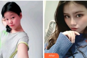 臺州國際眼科醫(yī)院葉良整形價(jià)格表附眼部綜合案例展示