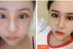 臺州國際眼科醫(yī)院余煥云整形價(jià)格表附切開雙眼皮案例展示