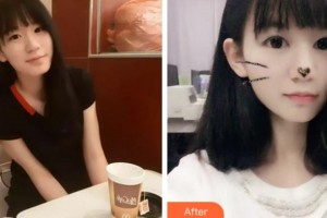 臺州國際眼科醫(yī)院曉整形價(jià)格表附切開雙眼皮案例展示