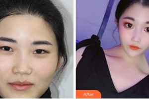 臺州國際眼科醫(yī)院徐肅仲整形價(jià)格表附眼部綜合案例展示