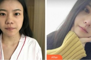 臺州國際眼科醫(yī)院汪育文整形價(jià)格表附切開雙眼皮案例展示