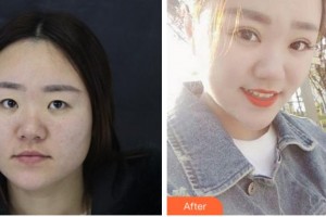 臺州國際眼科醫(yī)院鄧如芝整形價(jià)格表附眼部修復(fù)案例展示