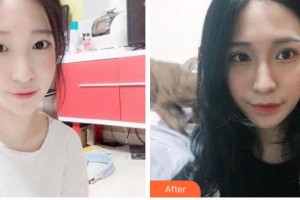 臺州國際眼科醫(yī)院陳惠整形價(jià)格表附埋線雙眼皮案例展示