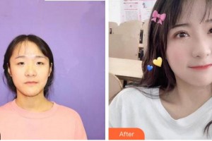 臺州妍度醫(yī)療美容門診部方奎整形價(jià)格表附眼部綜合案例展示