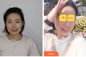 臺州拜博口腔醫(yī)院范沛沛整形價(jià)格表附牙齒隱形矯正案例展示