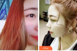 臺州康貝佳口腔醫(yī)院阮利芳整形價(jià)格表附超聲波潔牙案例展示