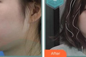 麗水樊承紅醫(yī)療美容診所沈月霞整形價格表附肋軟骨隆鼻案例展示