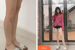 麗水市人民醫(yī)院整形燒傷外科朱薛峰整形價格表附激光祛疤案例展示