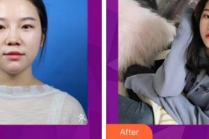 麗水慈愛醫(yī)院整形美容中心宋秀旭整形價格表附耳軟骨復合隆鼻案例展示