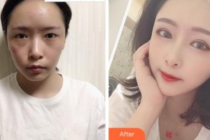 麗水慈愛醫(yī)院整形美容中心鄭承鎬整形價格表附眼部綜合案例展示